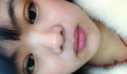 埋线减肥视频全过程,埋线减肥全过程揭秘